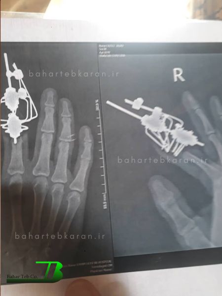 جراحی انگشت قطع شده