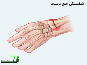 شکستگی مچ دست