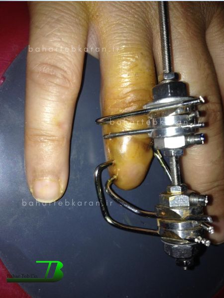 جراحی انگشت قطع شده